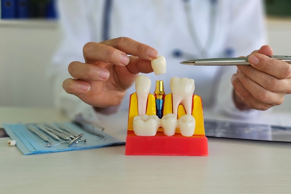 Dental Crown Vs  Filling: Which Is The Better Option?