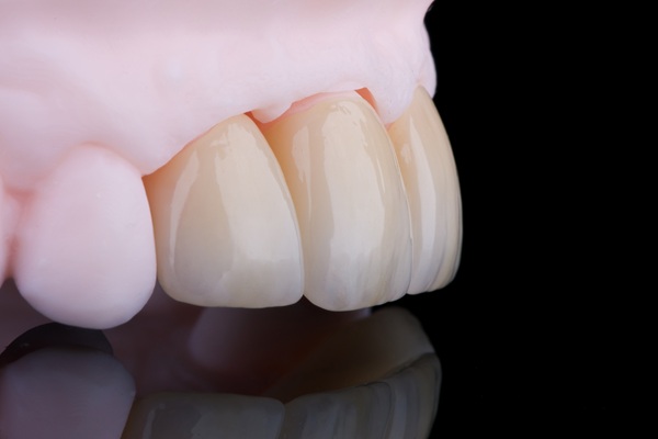 The Complete Guide To Dental Crowns: Types, Costs &#   ; Care
