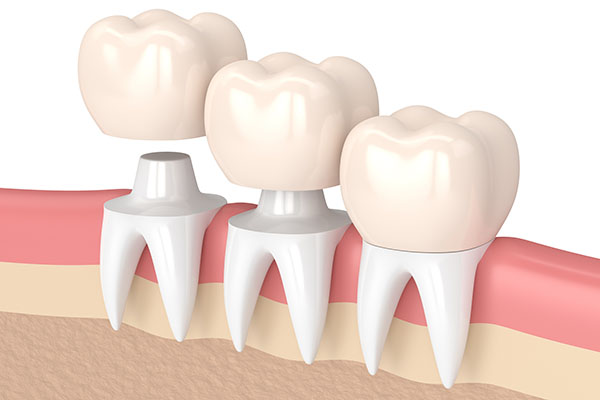 Dental Crowns Vs  Tooth Extraction